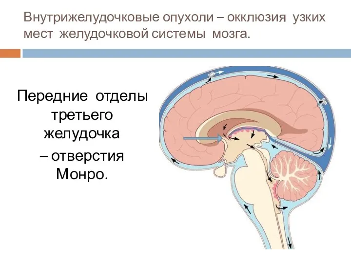 Внутрижелудочковые опухоли – окклюзия узких мест желудочковой системы мозга. Передние отделы третьего желудочка – отверстия Монро.