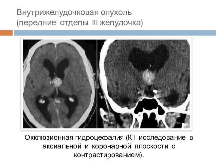 Внутрижелудочковая опухоль (передние отделы III желудочка) Окклюзионная гидроцефалия (КТ-исследование в аксиальной и коронарной плоскости с контрастированием).