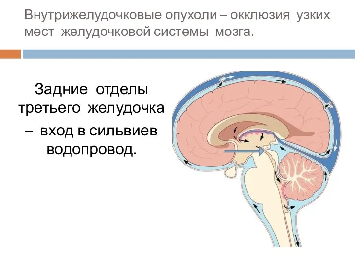 Внутрижелудочковые опухоли – окклюзия узких мест желудочковой системы мозга. Задние отделы третьего