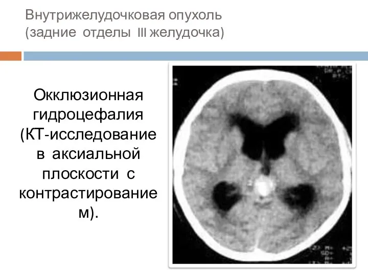 Внутрижелудочковая опухоль (задние отделы III желудочка) Окклюзионная гидроцефалия (КТ-исследование в аксиальной плоскости с контрастированием).