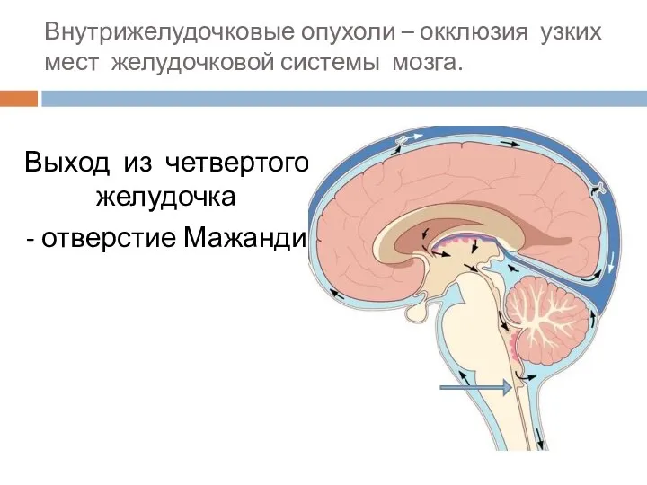 Внутрижелудочковые опухоли – окклюзия узких мест желудочковой системы мозга. Выход из четвертого желудочка - отверстие Мажанди