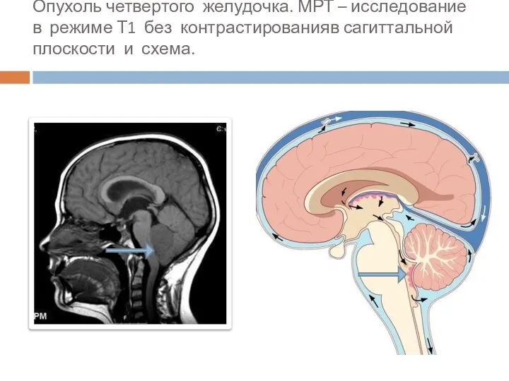 Опухоль четвертого желудочка. МРТ – исследование в режиме Т1 без контрастированияв сагиттальной плоскости и схема.