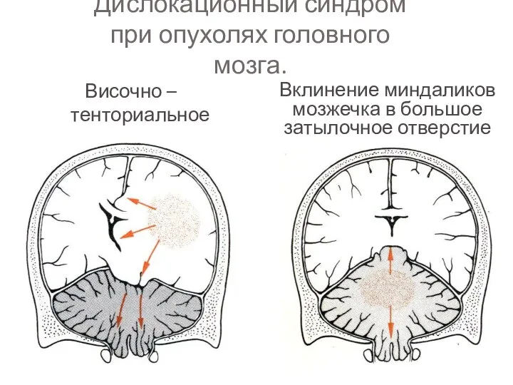 Дислокационный синдром при опухолях головного мозга. Височно – тенториальное вклинение Вклинение миндаликов