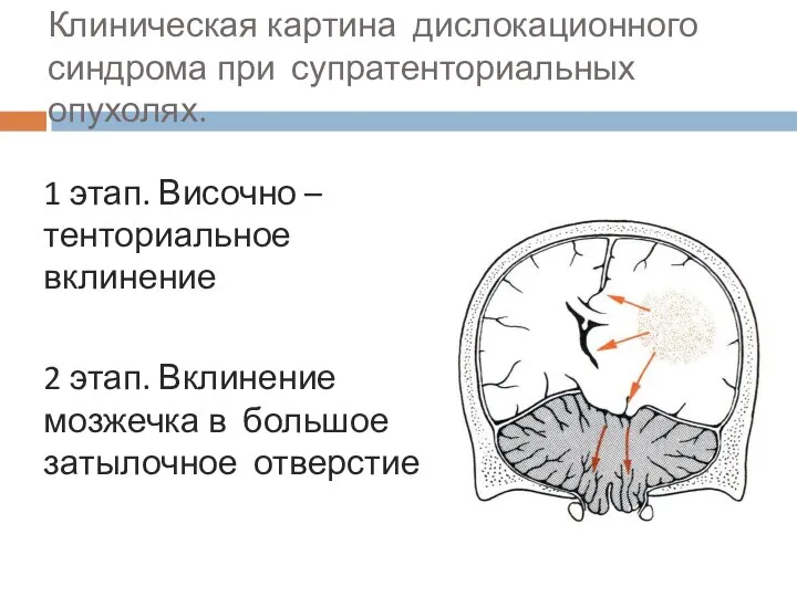 Клиническая картина дислокационного синдрома при супратенториальных опухолях. 1 этап. Височно – тенториальное