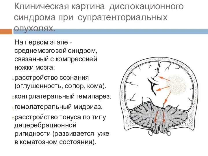 Клиническая картина дислокационного синдрома при супратенториальных опухолях. На первом этапе - среднемозговой