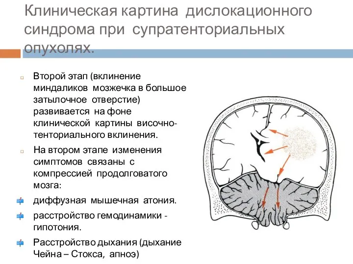 Клиническая картина дислокационного синдрома при супратенториальных опухолях. Второй этап (вклинение миндаликов мозжечка