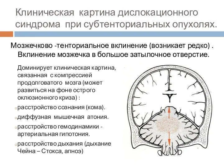 Клиническая картина дислокационного синдрома при субтенториальных опухолях. Мозжечково -тенториальное вклинение (возникает редко)