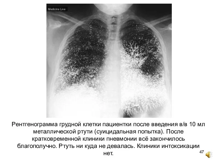 Рентгенограмма грудной клетки пациентки после введения в/в 10 мл металлической ртути (суицидальная