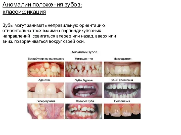 Аномалии положения зубов: классификация Зубы могут занимать неправильную ориентацию относительно трех взаимно