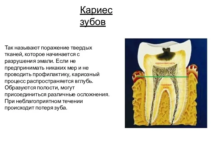 Кариес зубов Так называют поражение твердых тканей, которое начинается с разрушения эмали.