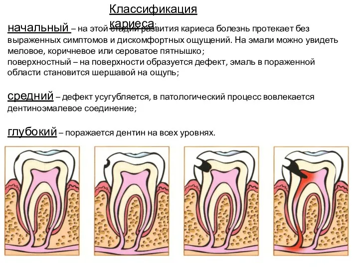 Классификация кариеса: начальный – на этой стадии развития кариеса болезнь протекает без