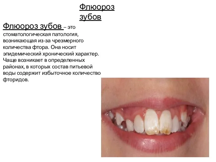 Флюороз зубов Флюороз зубов – это стоматологическая патология, возникающая из-за чрезмерного количества