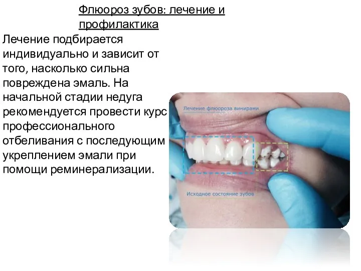 Флюороз зубов: лечение и профилактика Лечение подбирается индивидуально и зависит от того,