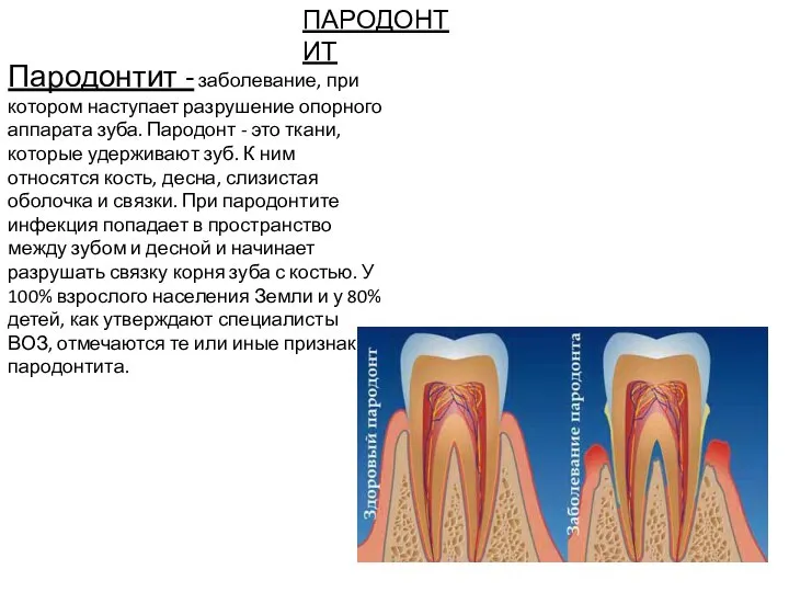 ПАРОДОНТИТ Пародонтит - заболевание, при котором наступает разрушение опорного аппарата зуба. Пародонт