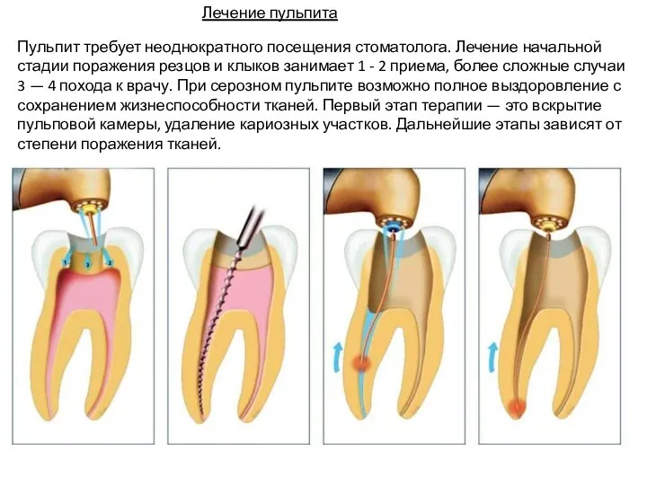 Лечение пульпита Пульпит требует неоднократного посещения стоматолога. Лечение начальной стадии поражения резцов