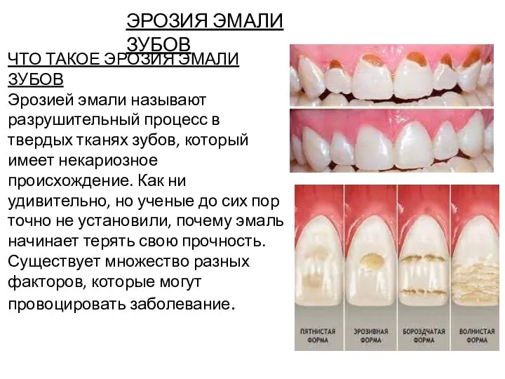 ЭРОЗИЯ ЭМАЛИ ЗУБОВ ЧТО ТАКОЕ ЭРОЗИЯ ЭМАЛИ ЗУБОВ Эрозией эмали называют разрушительный