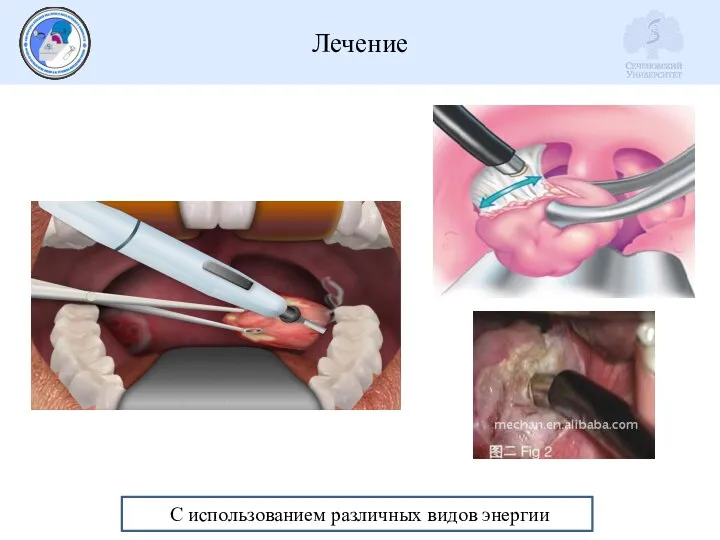 Лечение С использованием различных видов энергии
