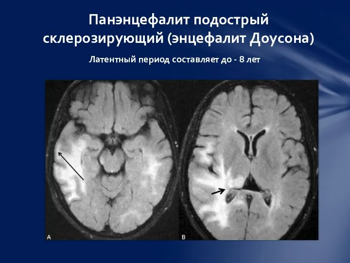 Латентный период составляет до - 8 лет Панэнцефалит подострый склерозирующий (энцефалит Доусона)