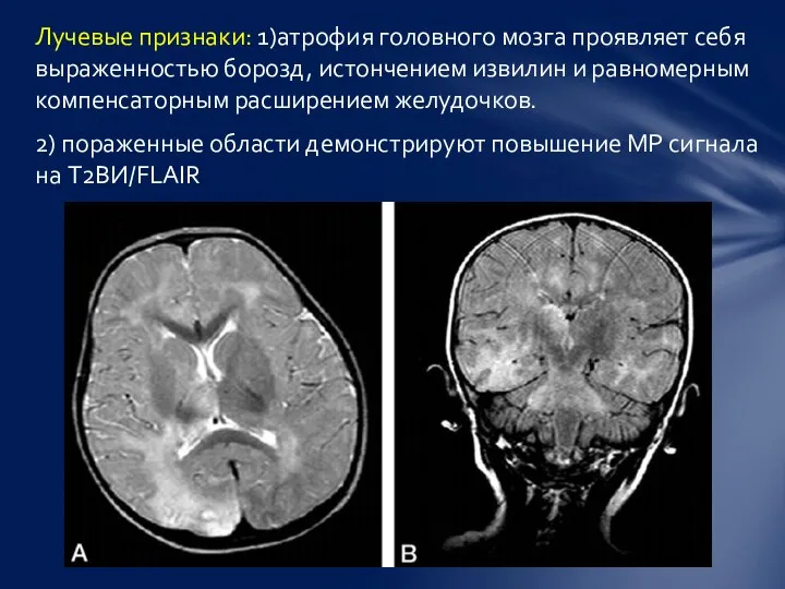 Лучевые признаки: 1)атрофия головного мозга проявляет себя выраженностью борозд, истончением извилин и