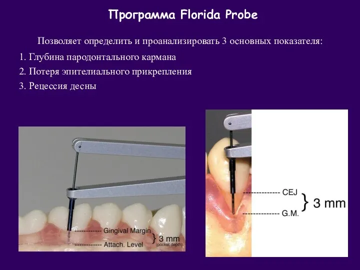 Позволяет определить и проанализировать 3 основных показателя: 1. Глубина пародонтального кармана 2.