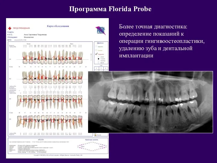 Более точная диагностика: определение показаний к операции гингивоостеопластики, удалению зуба и дентальной имплантации Программа Florida Probe