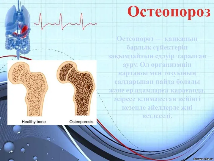 Остеопороз Остеопороз — қаңқаның барлық сүйектерін зақымдайтын едәуір таралған ауру. Ол организмнің