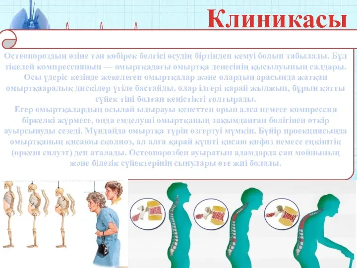 Клиникасы Остеопороздың өзіне тән көбірек белгісі өсудің біртіндеп кемуі болып табылады. Бұл