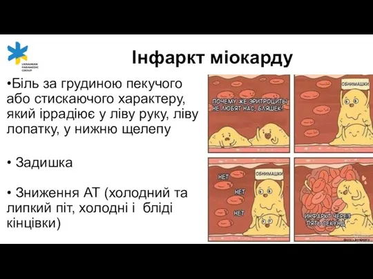 •Біль за грудиною пекучого або стискаючого характеру, який іррадіює у ліву руку,