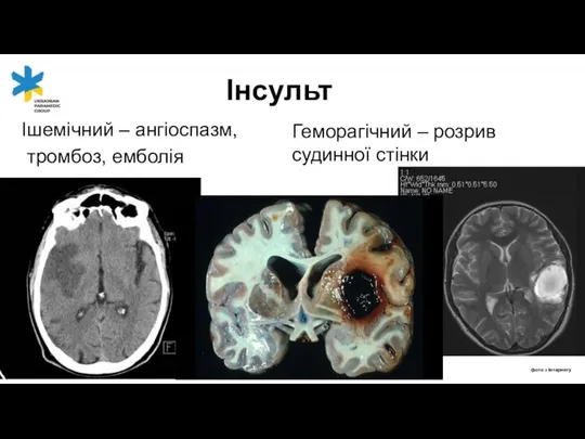 Ішемічний – ангіоспазм, тромбоз, емболія Інсульт фото з інтернету Геморагічний – розрив судинної стінки