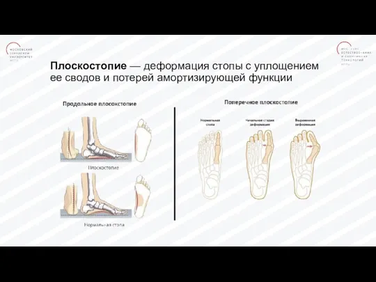 Плоскостопие — деформация стопы с уплощением ее сводов и потерей амортизирующей функции Хрусталик