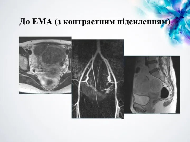 До ЕМА (з контрастним підсиленням)