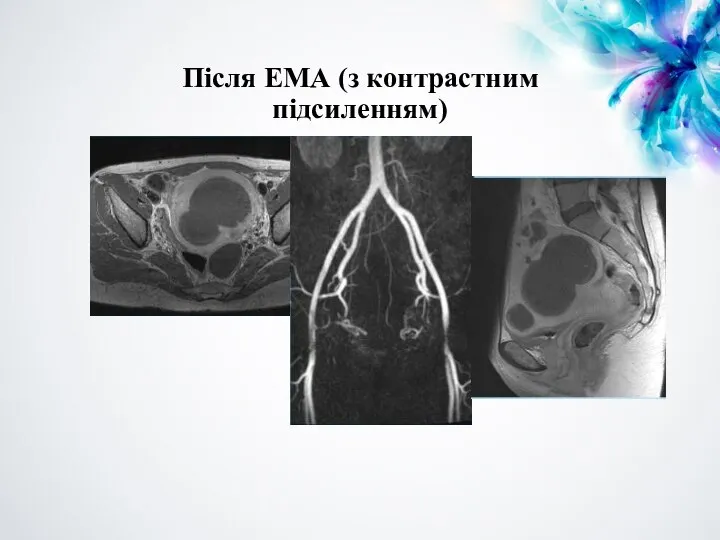 Після ЕМА (з контрастним підсиленням)