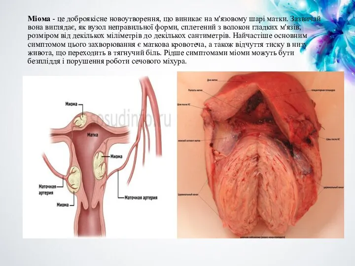 Міома - це доброякісне новоутворення, що виникає на м'язовому шарі матки. Зазвичай