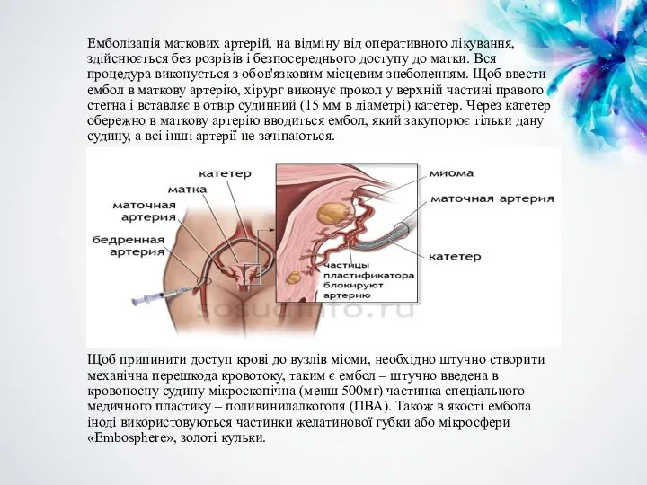 Емболізація маткових артерій, на відміну від оперативного лікування, здійснюється без розрізів і