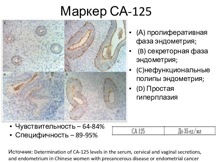 Маркер СА-125 (А) пролиферативная фаза эндометрия; (B) секреторная фаза эндометрия; (C)нефункциональные полипы