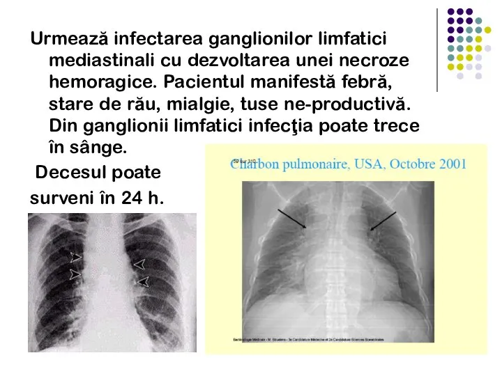 Urmează infectarea ganglionilor limfatici mediastinali cu dezvoltarea unei necroze hemoragice. Pacientul manifestă