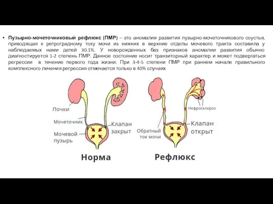 Пузырно-мочеточниковый рефлюкс (ПМР) – это аномалия развития пузырно-мочеточникового соустья, приводящая к ретроградному