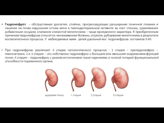 Гидронефроз – обструктивная уропатия, стойкое, прогрессирующее расширение почечной лоханки и чашечек на