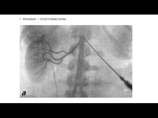 Аплазия — отсутствие почки