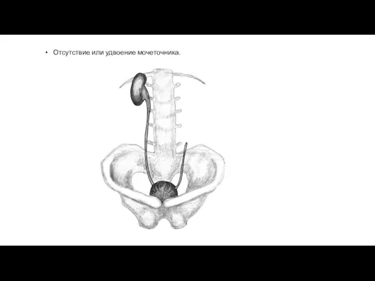 Отсутствие или удвоение мочеточника.