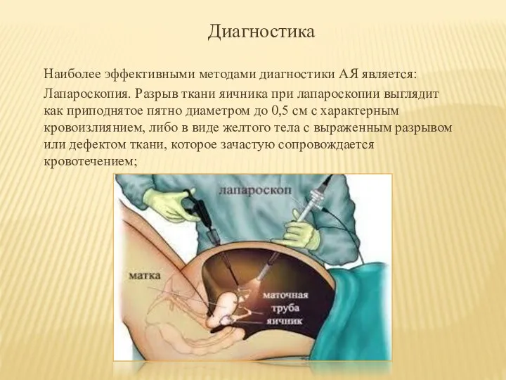 Диагностика Наиболее эффективными методами диагностики АЯ является: Лапароскопия. Разрыв ткани яичника при