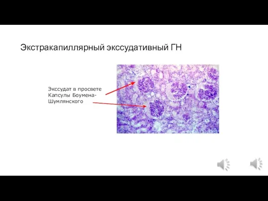 Экстракапиллярный экссудативный ГН Экссудат в просвете Капсулы Боумена- Шумлянского