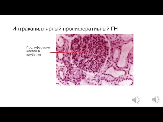 Интракапиллярный пролиферативный ГН Пролиферация клеток в клубочке