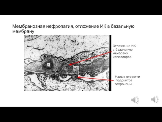 Мембранозная нефропатия, отложение ИК в базальную мембрану Отложение ИК в базальную мембрану