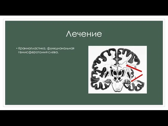 Лечение Краниопластика, функциональная гемисферотомия слева.