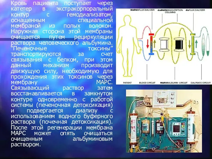 Кровь пациента поступает через катетер в экстракорпоральный контур с гемодиализатом, оснащенным специальной