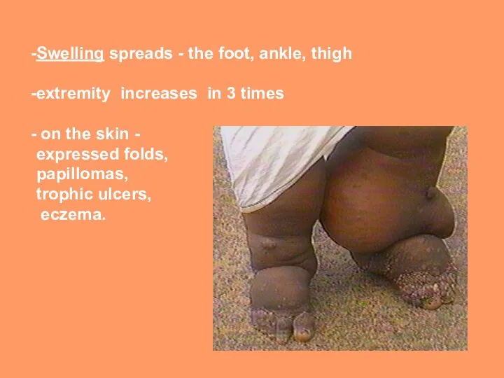Swelling spreads - the foot, ankle, thigh extremity increases in 3 times