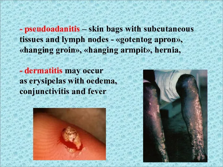 - pseudoadanitis – skin bags with subcutaneous tissues and lymph nodes -