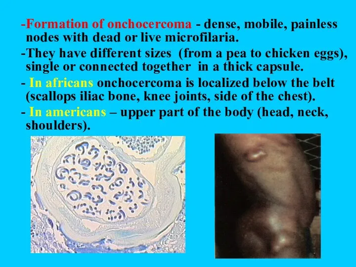 Formation of onchocercoma - dense, mobile, painless nodes with dead or live