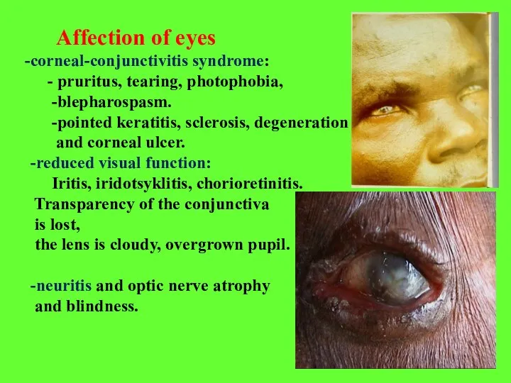 Affection of eyes corneal-conjunctivitis syndrome: - pruritus, tearing, photophobia, -blepharospasm. -pointed keratitis,